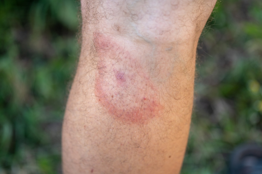 Mezi hlavní příznaky boreliózy patří červená skvrna na kůži s bledým středem, ale také únava, horečka, bolesti svalů a kloubů.